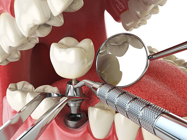 Best Emergency Dental Care for Sports Injuries in Marina, CA